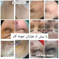 مدل کربوفیشیال(کربن تراپی+فیشال+پلاژن) کلینیکی|خدمات آرایشگری و زیبایی|تهران, گاندی|دیوار