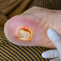 پرستاری، تزریقات، سرم تراپی