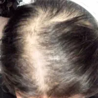 اگه مویی نمونده دو ماهه نتیجه بگیر با اکسونیک