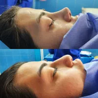 عمل رینوپلاستی