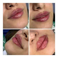 تخفیف تزریق ژل و بوتاکس