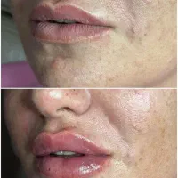 فیلر/ژل/بوتاکس/مزوتراپی/پی آر پی