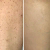 تنها لیزر موی زائد 2025 در سبزوار