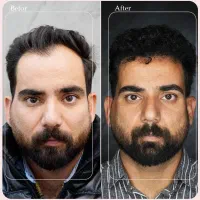 کاشت مو / اقساطی / نوین ایرانا