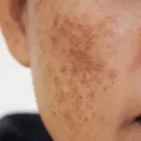 زخم و لک صورت و بدن