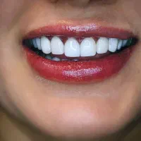 جشنواره اقساطی کامپوزیت لب شیشیه ای