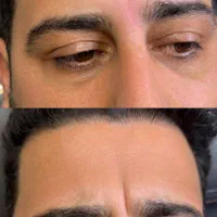 آموزش تزریقات ژل و بوتاکس|خدمات آموزشی|تهران, تهرانپارس غربی|دیوار