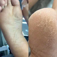 موخوره‌گیری بدون کوتاهی+پدیکور حرفه‌ای
