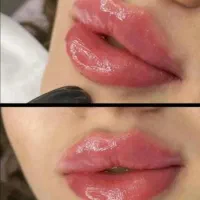 تزریق ژل و بوتاکس ومزو  درکلینیک