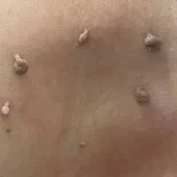 رفع منگوله و ضایعات پوستی
