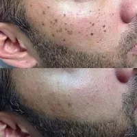 خدمات خالبرداری،برداشتن منگوله گوشتی|خدمات آرایشگری و زیبایی|تهران, مسعودیه|دیوار
