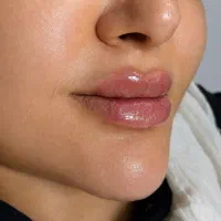 جشنواره بوتاکس و فیلر و لیزر|خدمات زیبایی و سلامت|اصفهان, فرهنگیان|دیوار