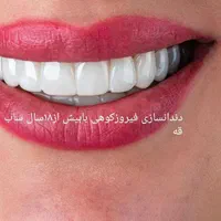 ساخت دندان مصنوعی تحویل یک روزژله