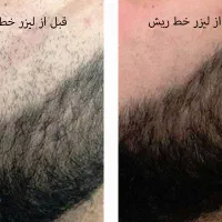 لیزر موهای زائد با قیمت ویژه برای اقایان