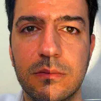 بلفاروپلاستی توسط متخصص چشم با بخیه سوپرنانو لیزری|خدمات آرایشگری و زیبایی|تهران, جردن|دیوار