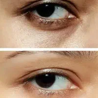وایتینگ  و جوانسازی صورت ،زیر بغل ،بیکینی