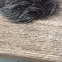 پروتز موی سر مردانه