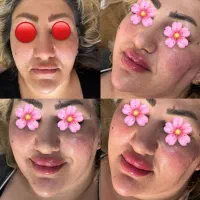 ژل بوتاکس پیرسینگ مزوژل آنزیم آموزش|خدمات آرایشگری و زیبایی|اسلام‌‌آباد غرب, |دیوار