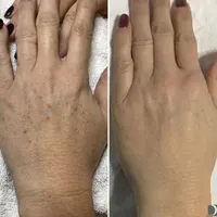 PRP/prpمو/prpصورت/درمان ریزش مو/درمان لک|خدمات آرایشگری و زیبایی|اصفهان, عباس‌آباد|دیوار