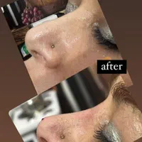 مزو ژل بوتاکس انزیم بینی پلکسرپیرسینگ پاکسازی|خدمات آرایشگری و زیبایی|پرند, فاز ۵|دیوار