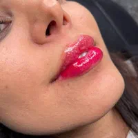 کلینیک تزریق ژل بوتاکس آنزیم فیلر لب شقیقه|خدمات آرایشگری و زیبایی|کرج, گوهردشت|دیوار