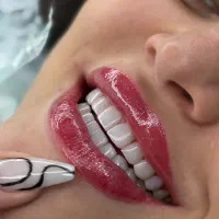 کامپوزیت دندان اقساطی جشنواره یلدایی(واحدی ۱ تومن)