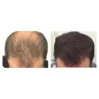 کاشت مو و ریش  super fue plus متد آلمان فقط ۱۳