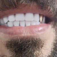 دندانسازی ساخت دندان (مصنوعی) متحرک