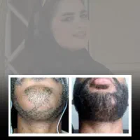 درمان ریزش سکه ای و پرپشتی مو