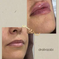 بوتاکس ژل فیلر چربی بلفاروپلاستی مزو PRP نخ لیزر|خدمات آرایشگری و زیبایی|شاهین‌شهر, فردوسی|دیوار