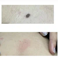 خال برداری و رفع کک ومک|خدمات آرایشگری و زیبایی|رشت, رودباری|دیوار