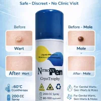 اسپری کرایو نیتروکسی خانگی اورجینال درمان زگیل HPV