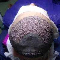 کاشت موی طبیعی|خدمات آرایشگری و زیبایی|شیراز, قدوسی شرقی|دیوار