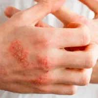 پماد اگزما. پسوریازیس. ضدخارش