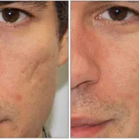 جشنواره تخفیف پی آر پی(PRP)/مزونیدلینگ مو و صورت|خدمات آرایشگری و زیبایی|اصفهان, جلفا|دیوار