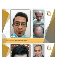 کاشت مو/تضمینی/توسط پزشک متخصص/نقد/اقساط|خدمات آرایشگری و زیبایی|پاکدشت, پاکدشت (مامازند)|دیوار