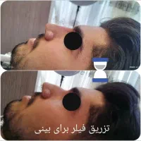 لیزر موهای زاید فیلر ژل بوتاکس مزو خال هایفو prp|خدمات آرایشگری و زیبایی|تبریز, |دیوار