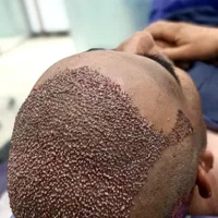 کاشت مو و کاشت ابرو وتزریق ژل و بوتاکس و مزو|خدمات آرایشگری و زیبایی|بهبهان, |دیوار