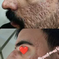 بازسازی درمان جای جوش آکنه باروش تخصصی NBR در کشور|خدمات آرایشگری و زیبایی|رشت, فلسطین|دیوار