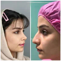 جشنواره قسطی جراحی عمل بینی لیفت ماموابدوشکم ژنیکو