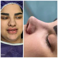 تخفیف عمل پلک و بینی و غبغب و لیپو و ابدو وترانسفر|خدمات آرایشگری و زیبایی|ورامین, ورامین|دیوار