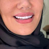 کامپوزیت دندان / طرح لبخند /با ضمانت کتبی و اقساط|خدمات آرایشگری و زیبایی|تهران, نارمک|دیوار