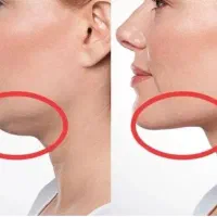 پیکرتراشی ساکشن غبغب بلفاروپلاستی ۵۰ درصد تخفیف