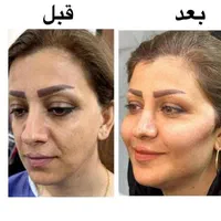 فیلر.ژل.بوتاکس.زاویه سازی.پی ارپی فول فیس|خدمات آرایشگری و زیبایی|مشهد, سناباد|دیوار
