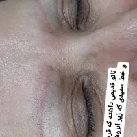 انجام خدمات میکروپیگمنتیشن