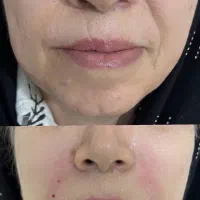 افتتاحیه کلینیک ژل و بوتاکس و آنزیم و مزونیدلینگ