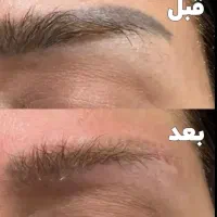 پاک کردن قطعی تتو و لک بالیزر پیکوشور (بدون اسکار)