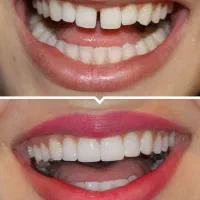 عمل زیبایی درمانی دندان دهان و دندانپزشکی دکتریاب|خدمات زیبایی و سلامت|شیراز, معالیآباد|دیوار