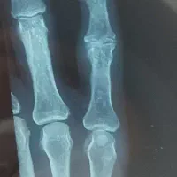 شکسته بندی کریمی