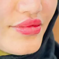 تزریق ژل و بوتاکس با تخفیف ویژه بهاری*|خدمات آرایشگری و زیبایی|جوانرود, |دیوار